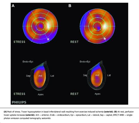 benzidine test|cardiac perfusion stress mibi.